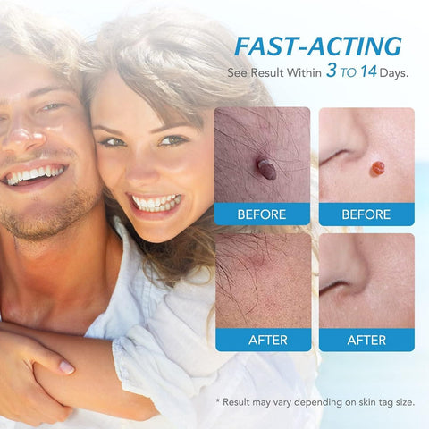 2 in 1 Skin Tag Remover Kit - Painless Robykart