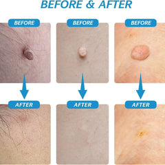 2 in 1 Skin Tag Remover Kit - Painless Robykart