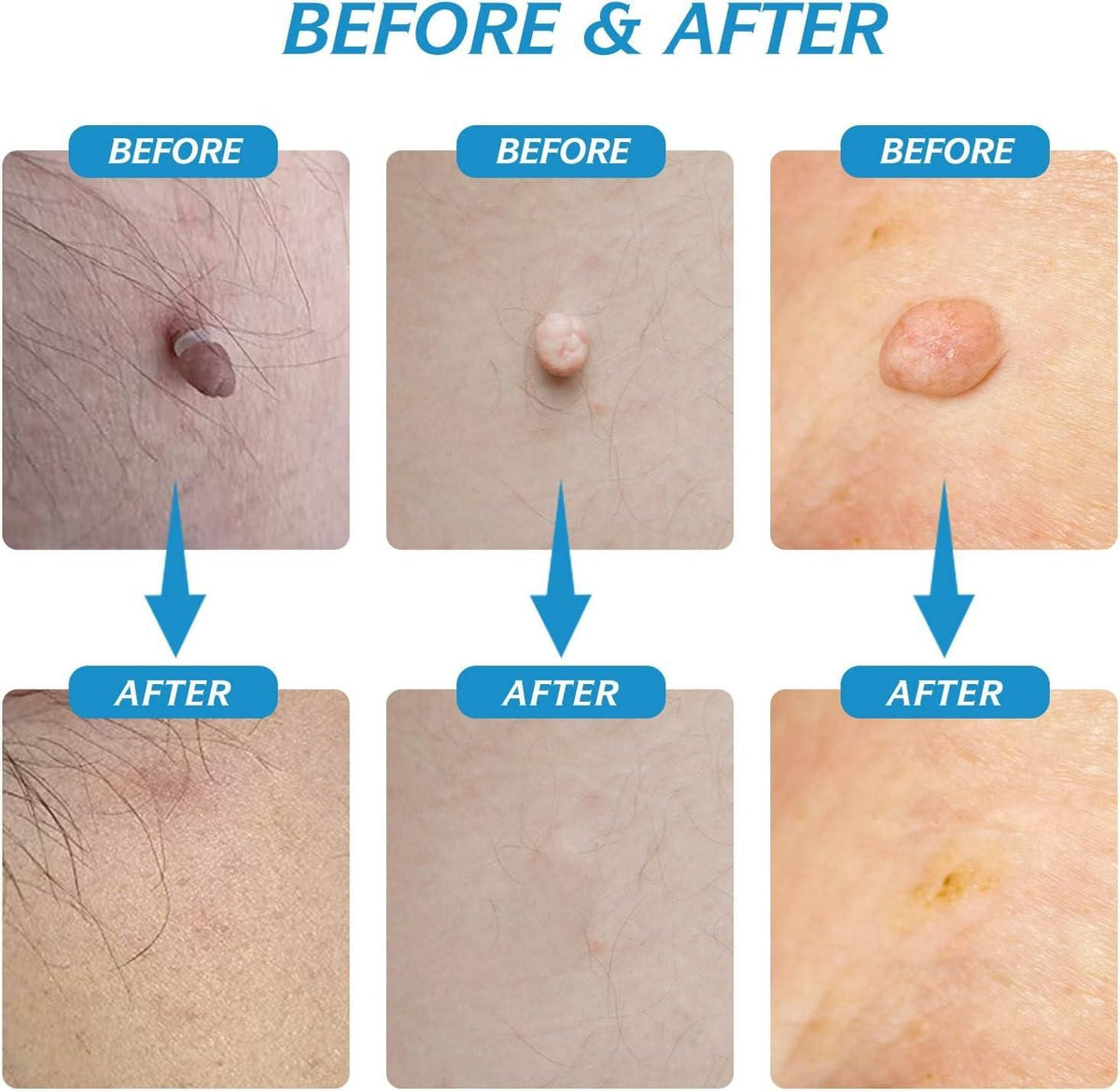 2 in 1 Skin Tag Remover Kit - Painless Robykart